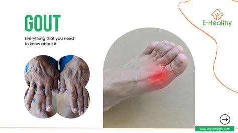 Gout: Symptoms, Diagnosis, Causes, and Treatment - E Healthy Info