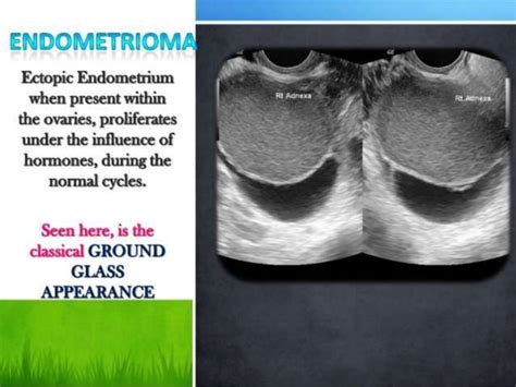 Basic gynae ultrasound