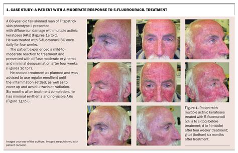 Actinic keratoses – a guide to treatment with 5-fluorouracil cream ...