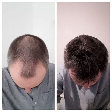 Four months on minoxidil 5% spray. I'm really glad I gave it a chance ...