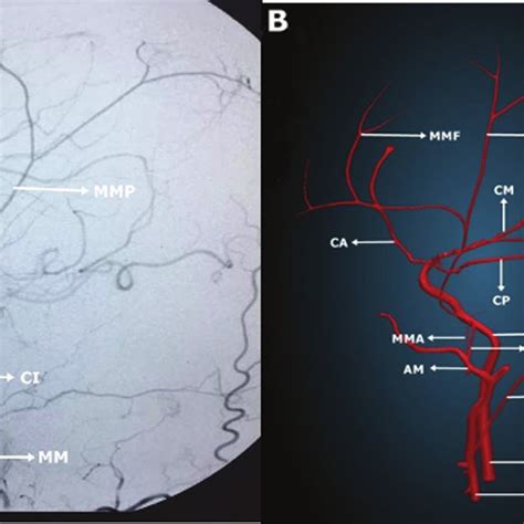 (PDF) Anatomy of the Middle Meningeal Artery