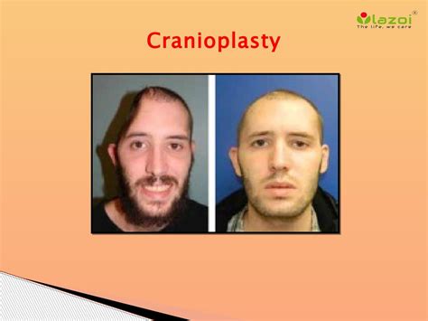 Cranioplasty by lazoithelife - Issuu