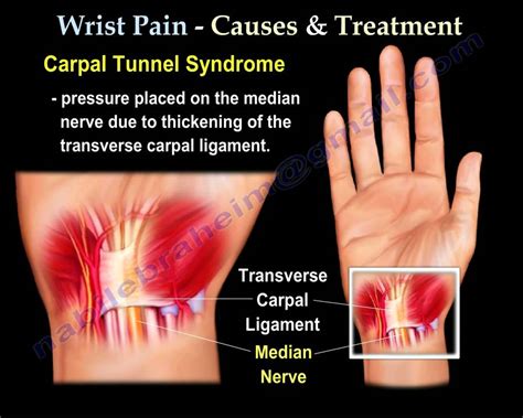 Wrist Pain Nerve Damage - mapageprek