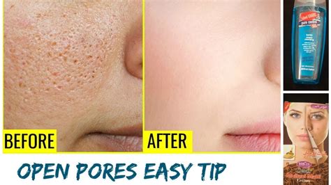 How to close large open pores naturally and permanently at home in few ...