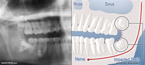 Wisdom Teeth Saint Marys GA | Third Molars | Impacted Tooth