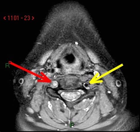 Neurogenic pulmonary oedema secondary to vertebral artery dissection ...