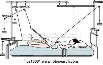 Principle of balanced suspension traction. The counterweight and ...