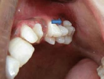 Extra cusp on the mesiobuccal aspect of the maxillary left first molar ...