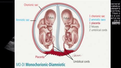 Monochorionic Diamniotic Twins Ultrasound