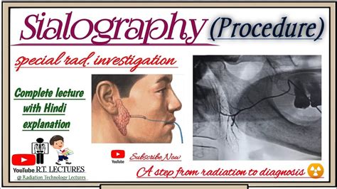 #Sialography Procedure Complete Lecture// #Sialography radiology ...