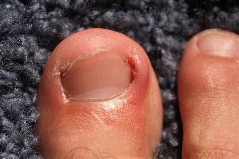 Ingrown Toenail In Children: 6 Causes And 7 Treatments