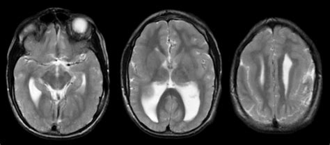 Cobblestone Lissencephaly