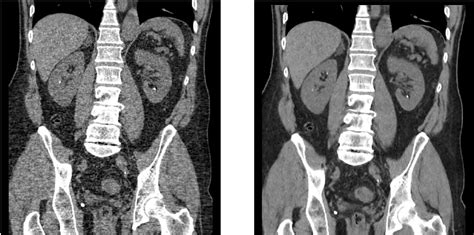 Ultra Low-dose CT KUB – Hawaii Diagnostic Radiology Services by Y&M