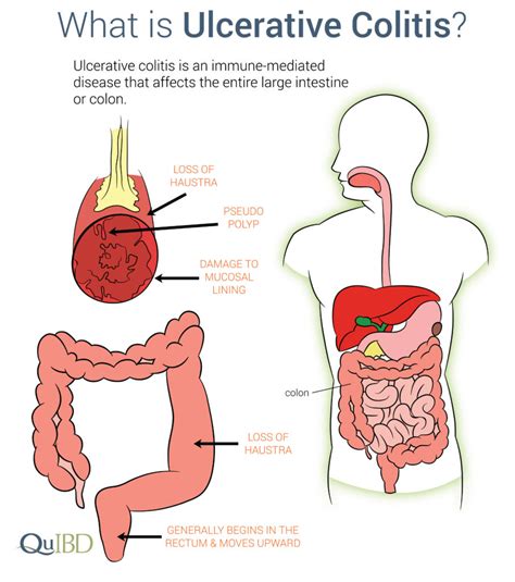 Ulcerative Colitis Symptoms IBD Prevalence Impact Causes