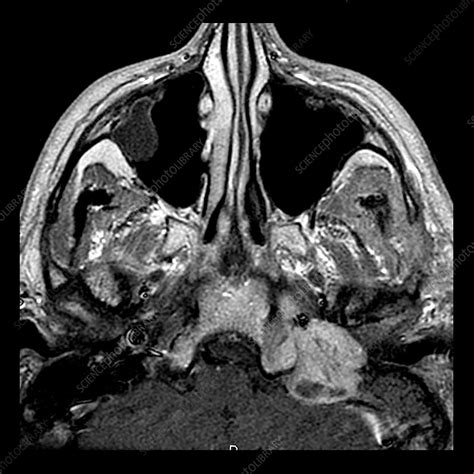 Jugular Foramen Mri