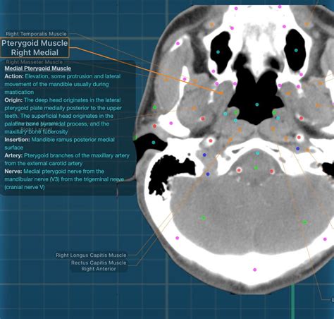 Medial Pterygoid Muscle - Review and CT images : r/XAnatomy