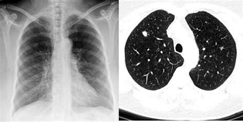 University Hospitals in Cleveland to offer $99 lung cancer screening ...