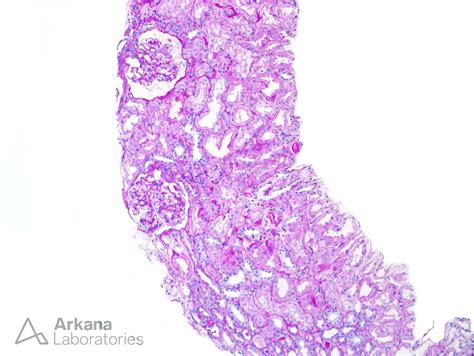 Light Chain Deposition Disease | Teaching Points | Arkana Laboratories