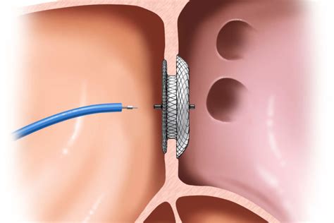 DEVICE CLOSURE OF ASD/VSD/PDA | Dr. Tejas V. Patel | Cardiologist in ...