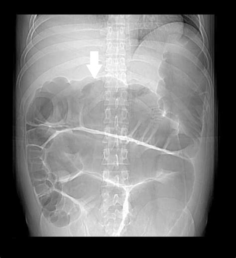 Cureus | Chronic Intestinal Pseudo-Obstruction in a Young Male With ...