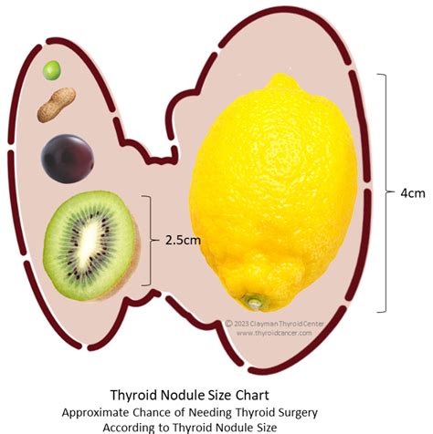 Things to Know About Thyroid Nodule Size, Plus Size Chart