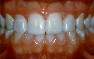 Teeth Bonding | Tooth Bonding | Teeth Gaps