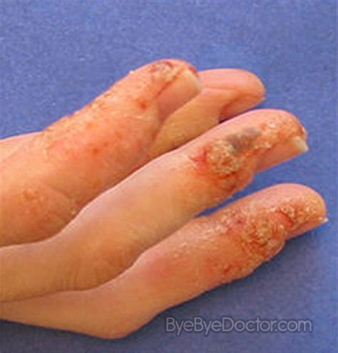 Dyshidrotic Eczema – Pictures, Causes, Home Remedies, Treatment