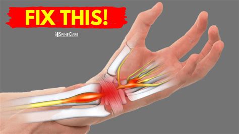 How to Fix Wrist Pain for Good | SpineCare | St. Joseph, Michigan