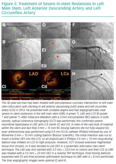 Contemporary Management of Stent Failure: Part One | ICR Journal