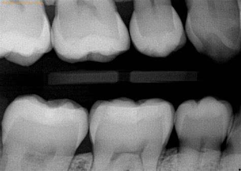 What Does A Cavity Look Like On An X-Ray? - 1311 Jackson Ave Dental ...