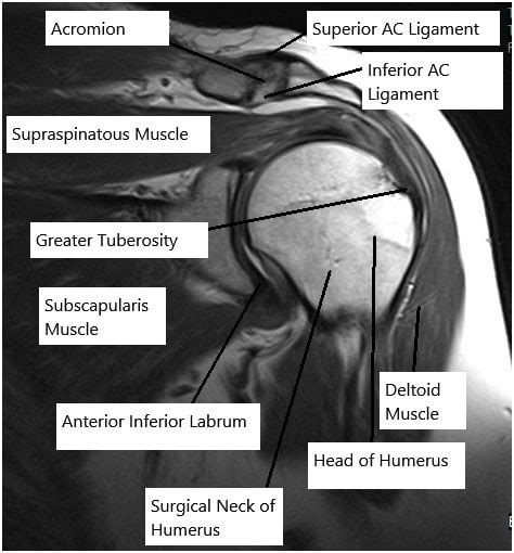 Rotator Cuff Tear New York | Shoulder Specialist