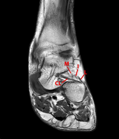 Sinus Tarsi Mri