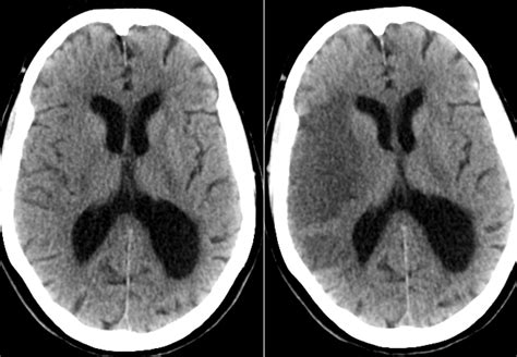 Acute MCA Infarct on CT - Radiology Imaging