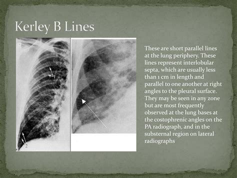 PPT - Diagnostic Radiology: Congestive Heart Failure PowerPoint ...