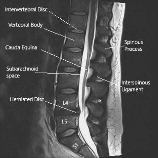 Sciatic Nerve - Anatomy - Complete Orthopedics & Podiatry | Multiple NY ...