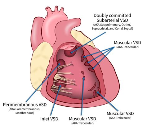 Ventricular Septal Defect Types