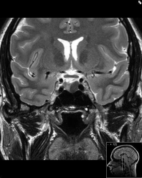 Pituitary Tumor Mri