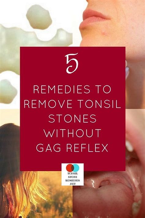 5 Home remedies that can easily remove tonsil stones without any gag ...