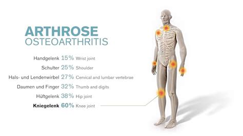 What causes osteoarthritis | Ottobock US