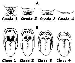 Mallampati Score | Medically Speaking