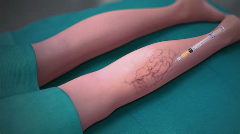 Treating Varicose Veins: Focus on Sclerotherapy - Scientific Animations