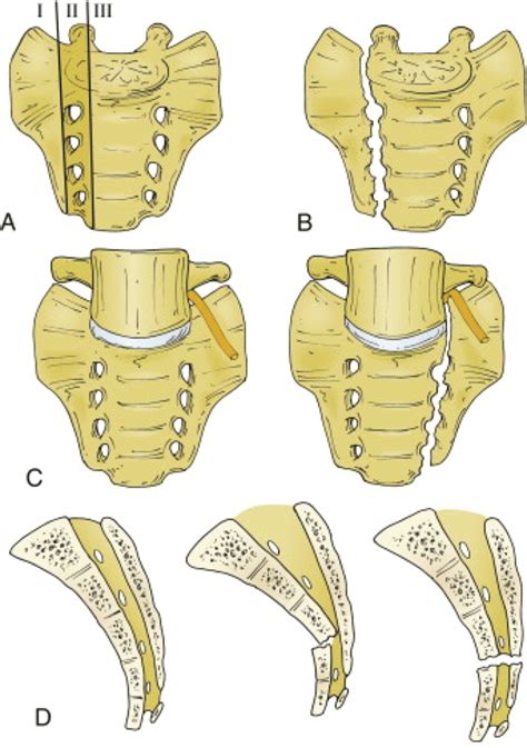 Sacral Fracture Classification