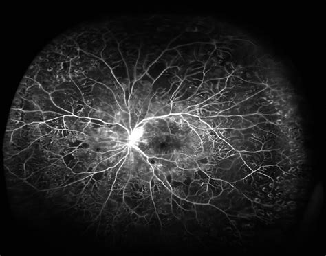 Fluorescein Angiogram of Proliferative Diabetic Retinopathy - Retina ...