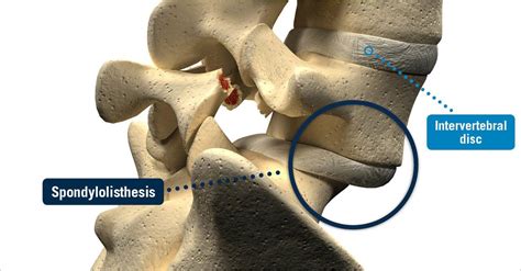 Spondylolisthesis - USA Spine Care - Laser Spine Surgery