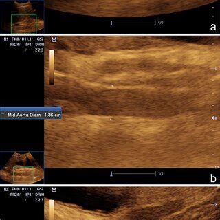 Longitudinal ultrasound scans between the epigastric and umbilical ...