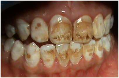 Tooth Stain/Discoloration- Know Causes, Prevention & Treatments