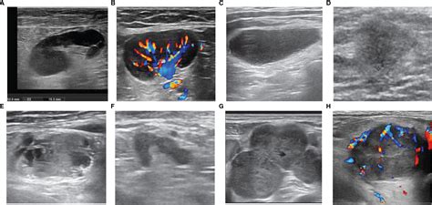 Frontiers | Diagnostic Model of Superficial Lymph Nodes Based on ...