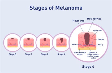 Stage 4 - Melanoma Focus