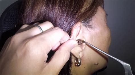 Removing Insect From Ear