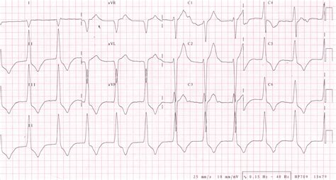 Idioventricular rhythm